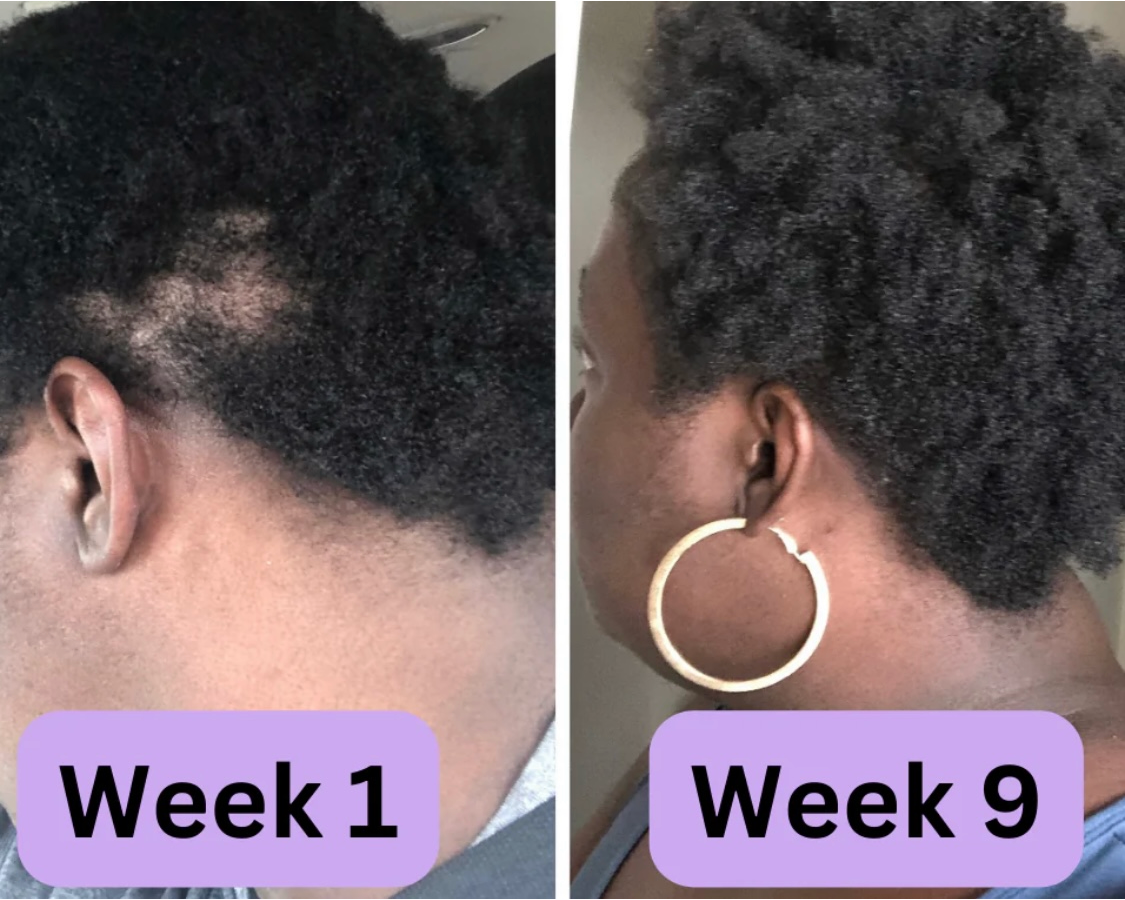 Hair Loss Treatment Set for Women