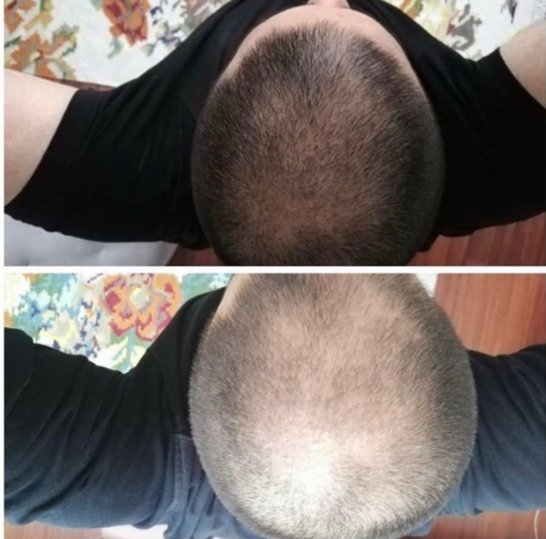 Hair Loss Treatment Set for Men