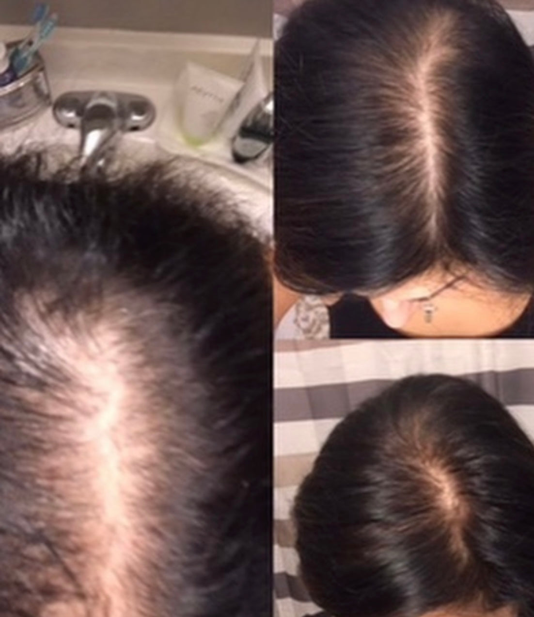 Hair Loss Treatment Set for Women