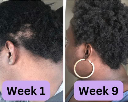 Hair Loss Treatment Set for Women